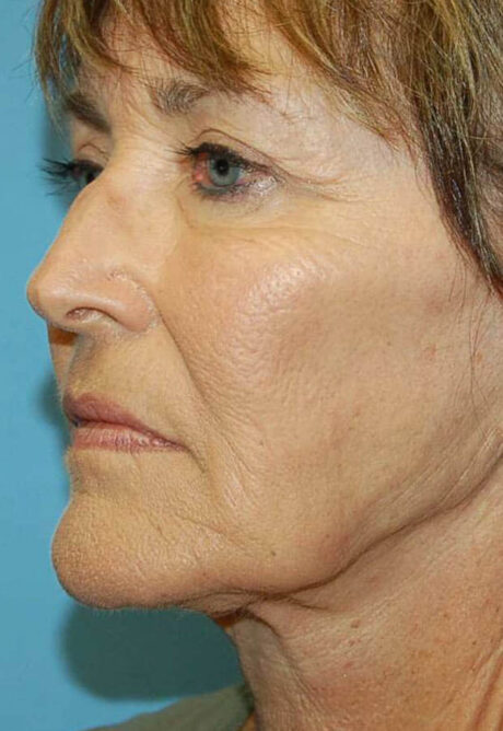 Neck Lift case #5115