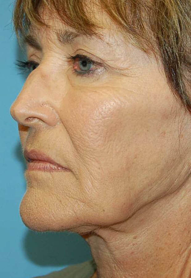 Neck Lift case #5115