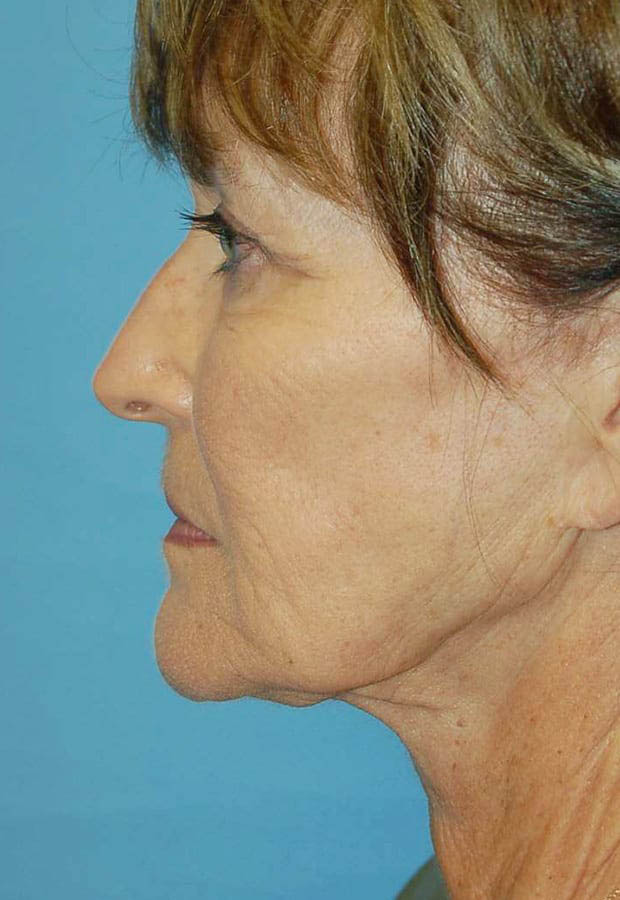Neck Lift case #5115