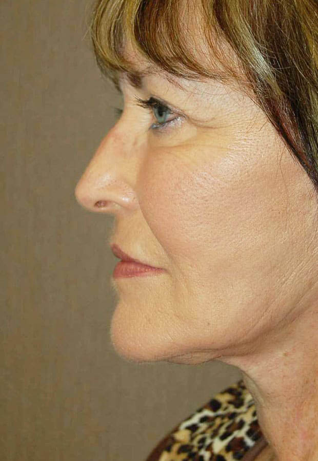 Neck Lift case #5115