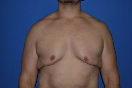 Tummy Tuck case #5450