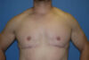 Tummy Tuck case #5450