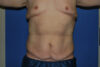 Tummy Tuck case #5450