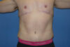 Tummy Tuck case #5450