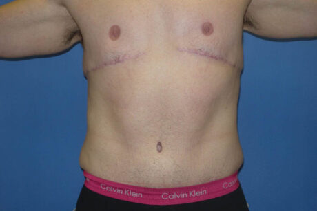 Tummy Tuck case #5450