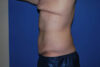 Tummy Tuck case #5450