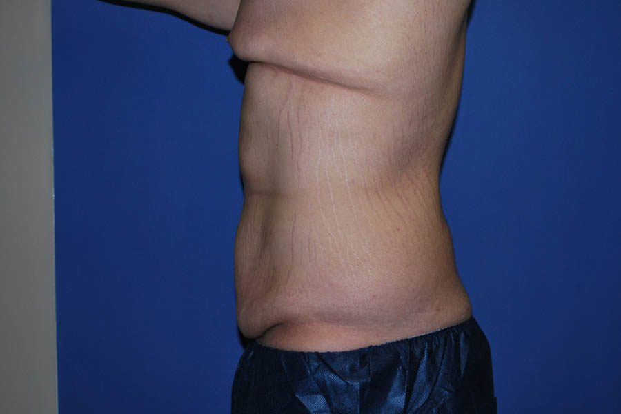 Tummy Tuck case #5450