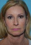 Neck Lift case #5131