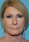 Neck Lift case #5131