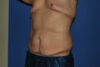 Tummy Tuck case #5450