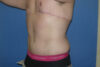 Tummy Tuck case #5450