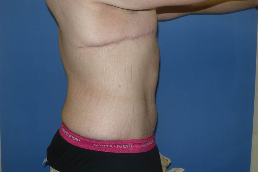 Tummy Tuck case #5450