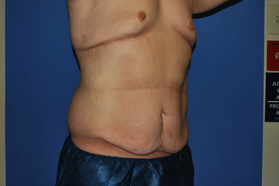 Tummy Tuck case #5450