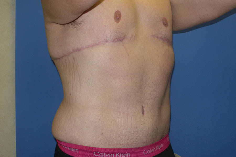 Tummy Tuck case #5450