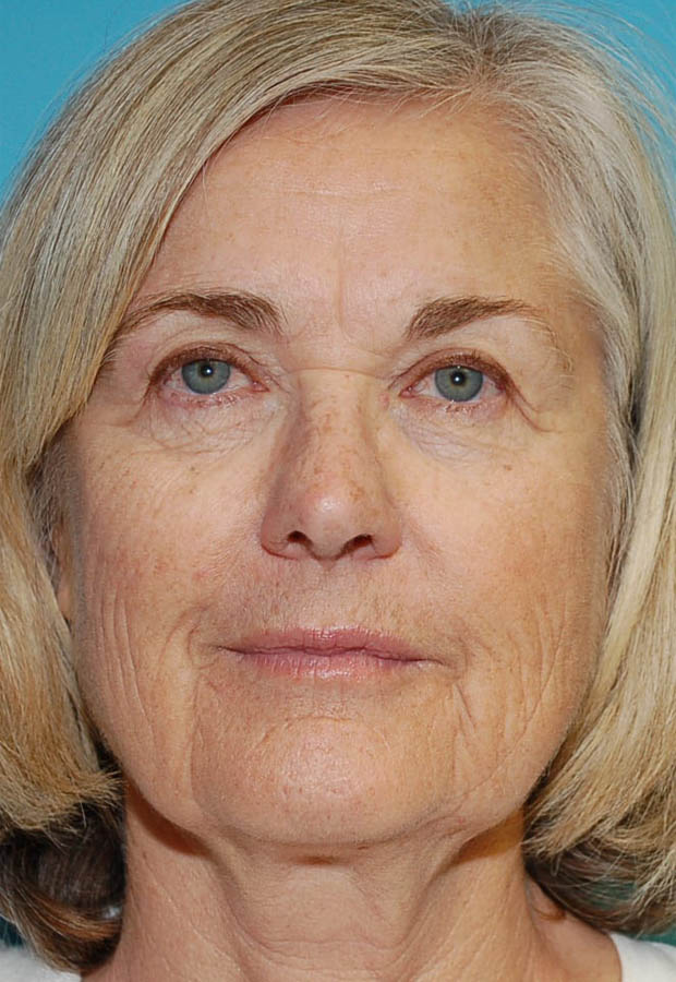 Neck Lift case #5141