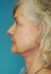 Neck Lift case #5141