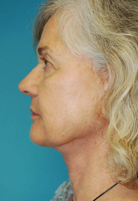 Neck Lift case #5141