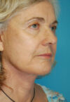 Neck Lift case #5141