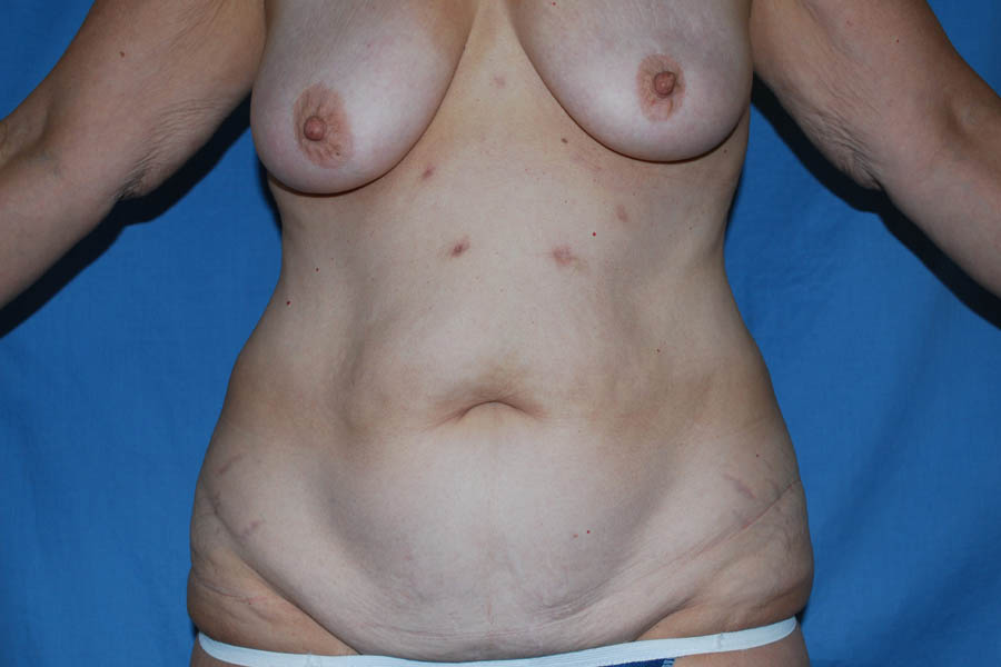 Liposuction case #4685