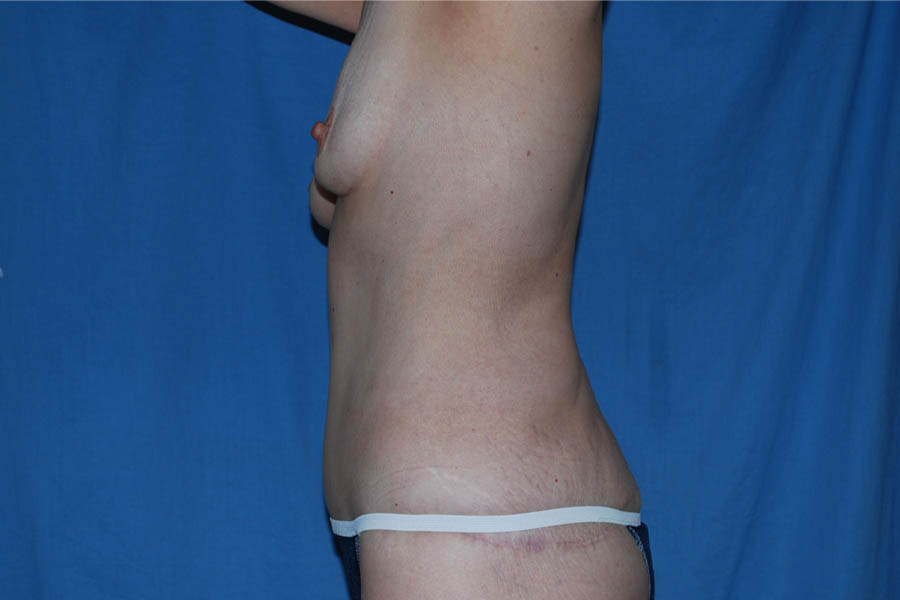Liposuction case #4685