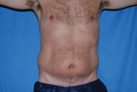 Liposuction case #4707