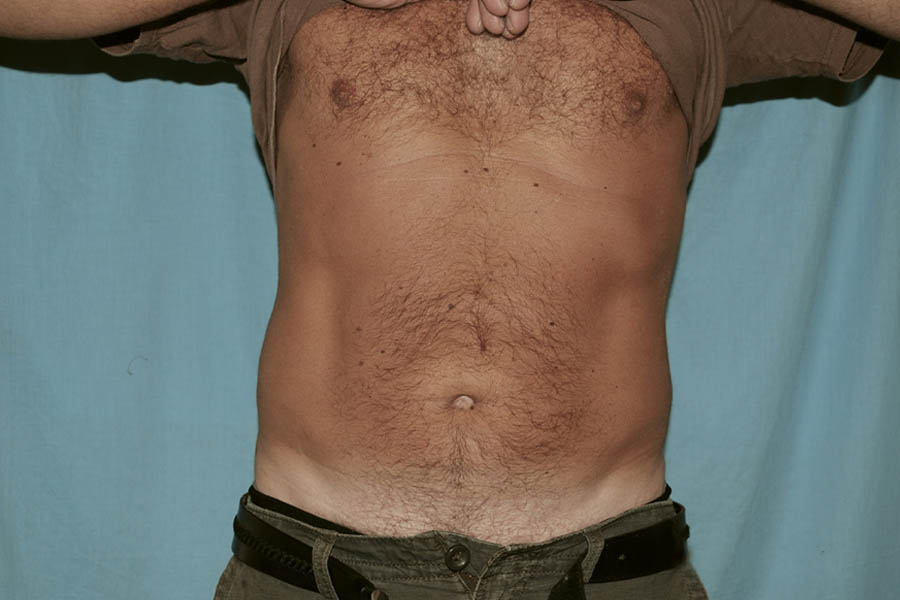 Liposuction case #4707