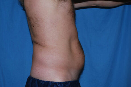 Liposuction case #4707