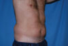 Liposuction case #4707