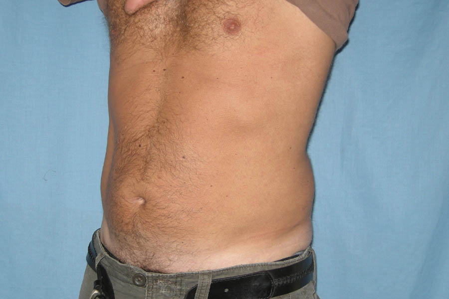 Liposuction case #4707