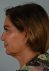 Neck Lift case #5181
