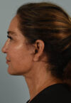 Neck Lift case #5181