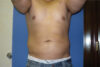 Liposuction case #4725