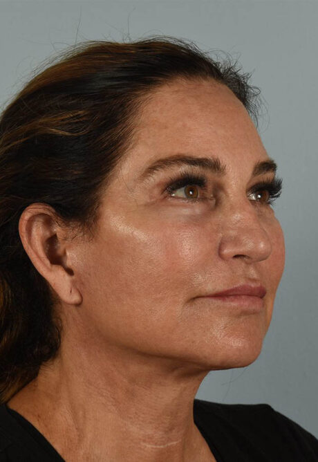 Neck Lift case #5181