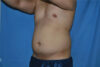 Liposuction case #4725
