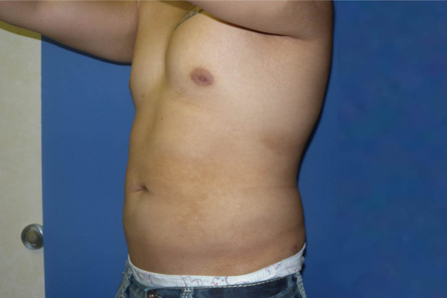 Liposuction case #4725