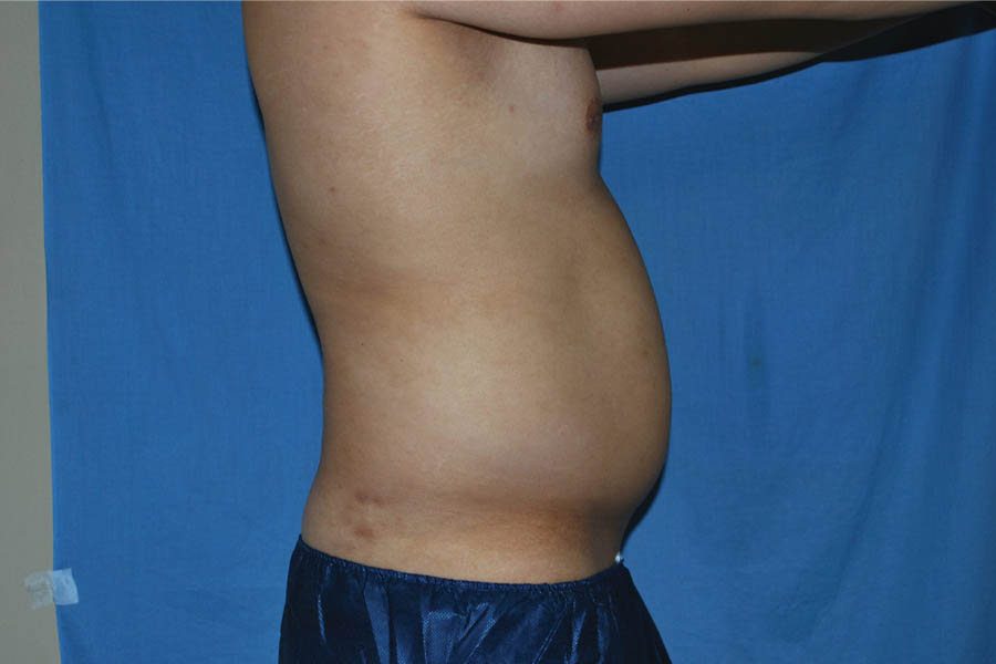 Liposuction case #4725