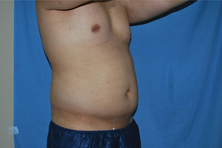 Liposuction case #4725