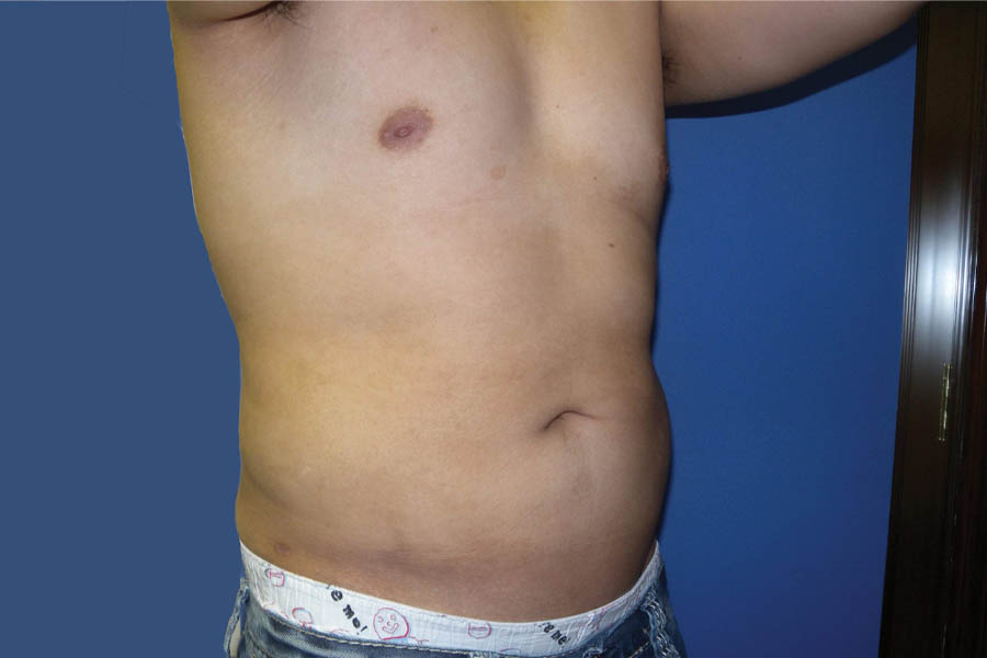Liposuction case #4725