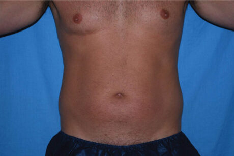 Liposuction case #4736