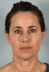 Neck Lift case #5203