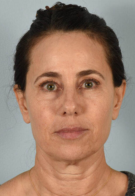 Neck Lift case #5203