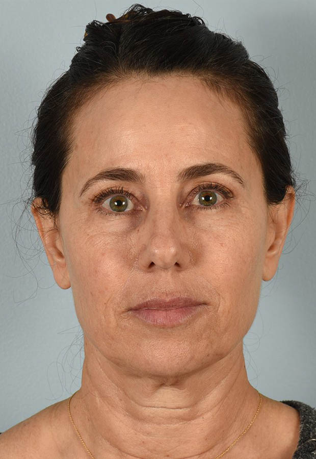 Neck Lift case #5203