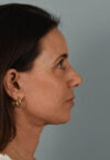 Neck Lift case #5203