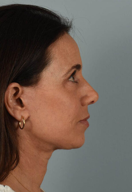 Neck Lift case #5203
