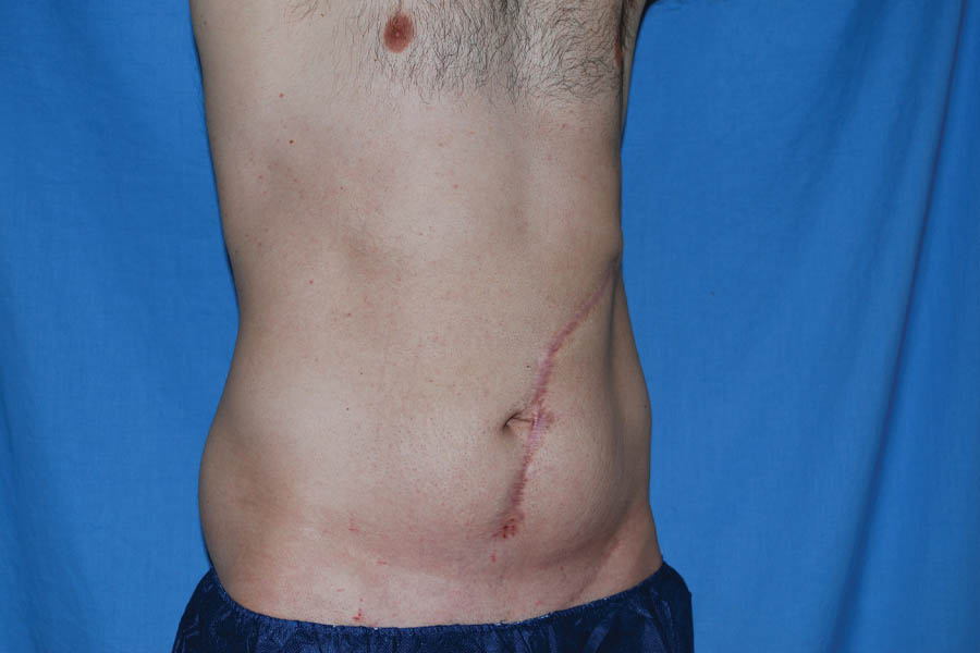 Liposuction case #4748
