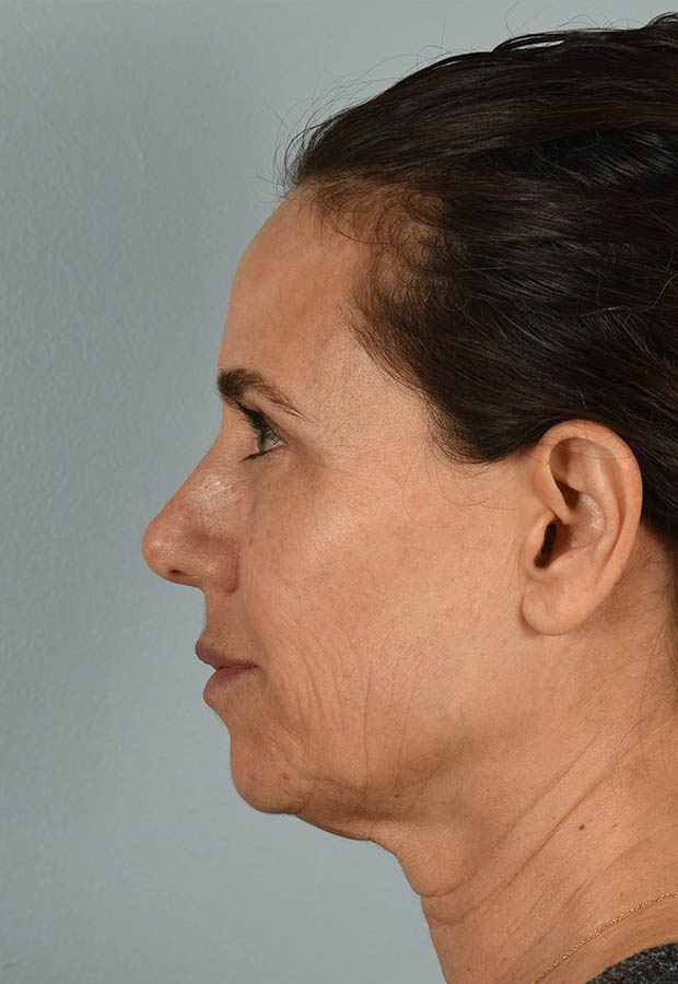 Neck Lift case #5203
