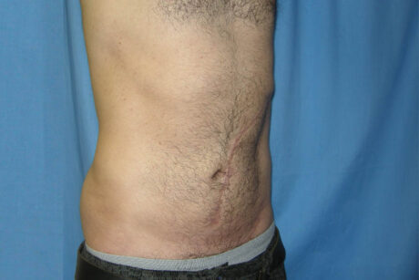 Liposuction case #4748