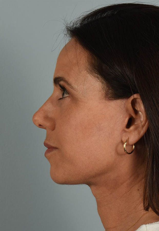 Neck Lift case #5203