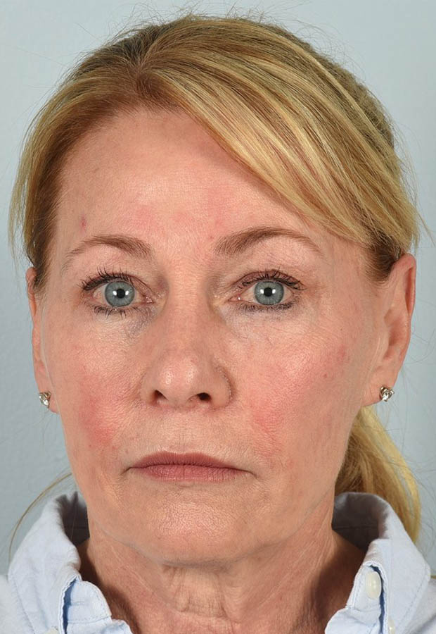 Neck Lift case #5214