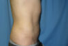 Liposuction case #4748